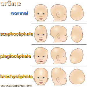 plagiocéphalie 